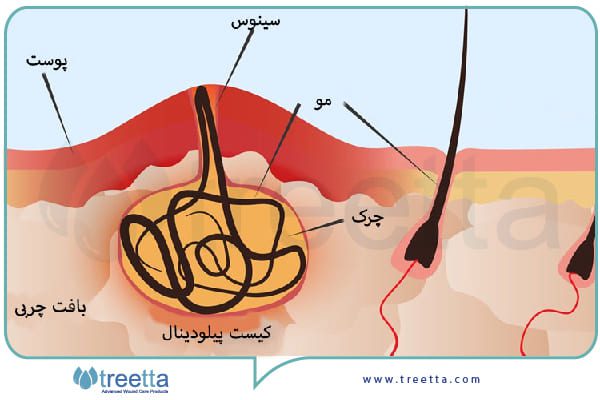 جراحی کیست مویی