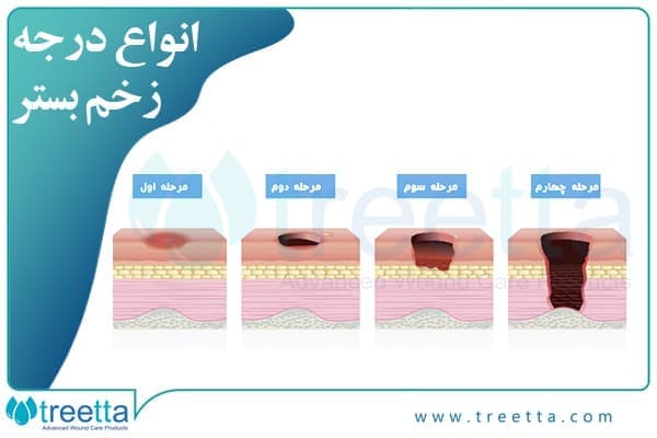 انواع درجه زخم بستر